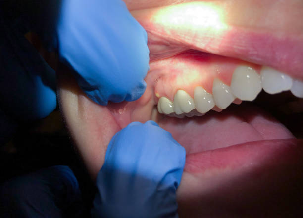 Best Emergency Root Canal Treatment in Crest, CA